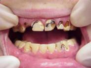 Methamphetamines