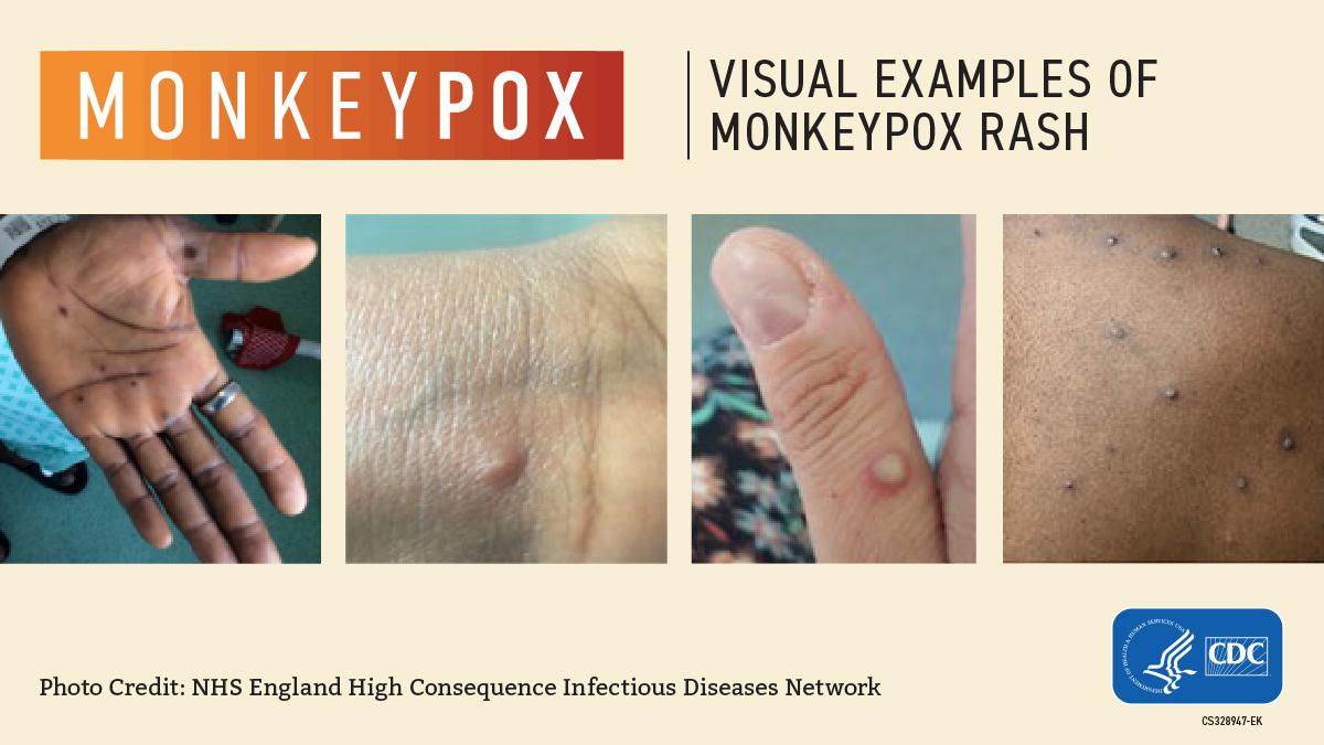 visual examples of MPX rash